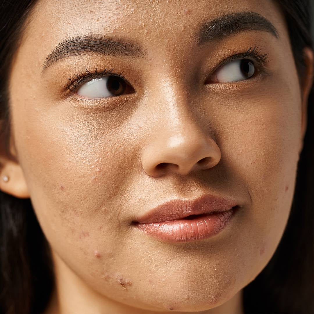 SKINPURE NIKSPRO™ | Complément Peau Pure Anti-Acné en Gélules